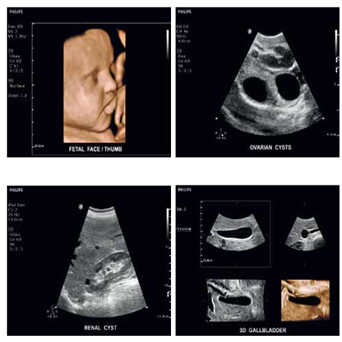 Изображение УЛЬТРАЗВУКОВОЙ АППАРАТ CLEARVUE 650