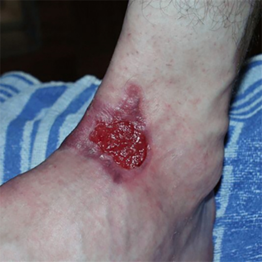 КЛИНИЧЕСКИЙ СЛУЧАЙ №1. ЛЕЧЕНИЕ ОЖОГА