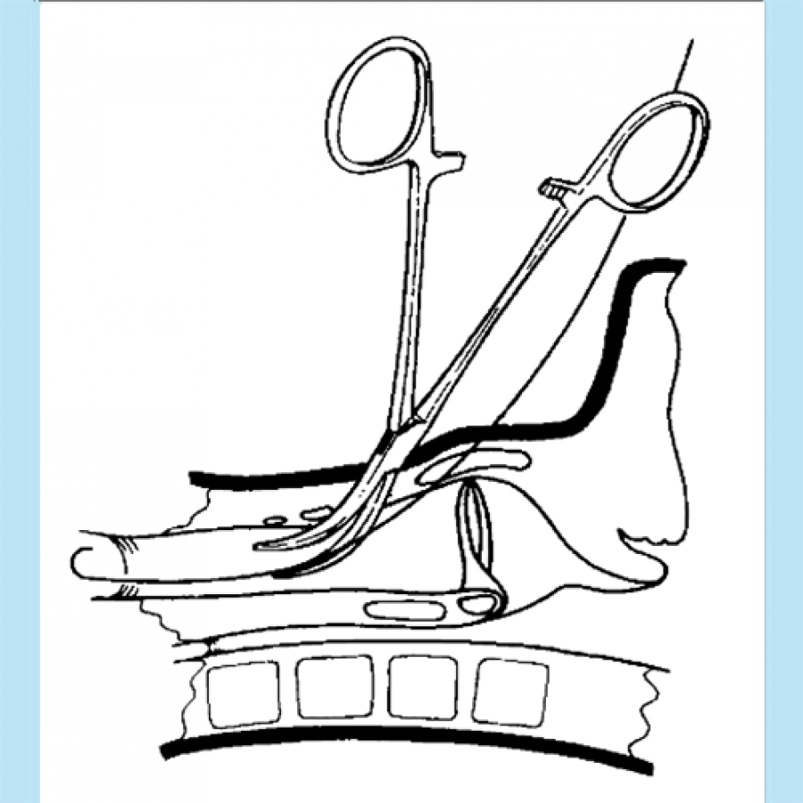 ЧРЕСКОЖНАЯ ТРАХЕОСТОМИЯ ПО ГРИГГСУ (ПРЕЗЕНТАЦИЯ)
