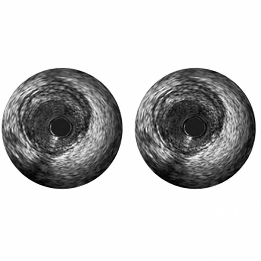 VOLCANO РЕЖИМ ВСУЗИ РОТАЦИОННЫЕ КАТЕТЕРЫ REFINITY